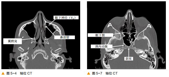 影像PPT - 颅底及鼻窦CT轴冠矢解剖-4