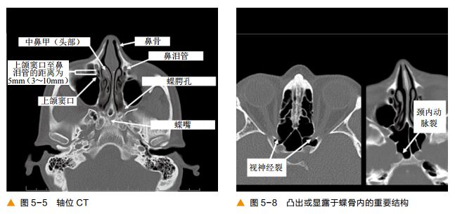 影像PPT - 颅底及鼻窦CT轴冠矢解剖-5