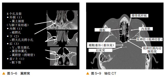 影像PPT - 颅底及鼻窦CT轴冠矢解剖-6