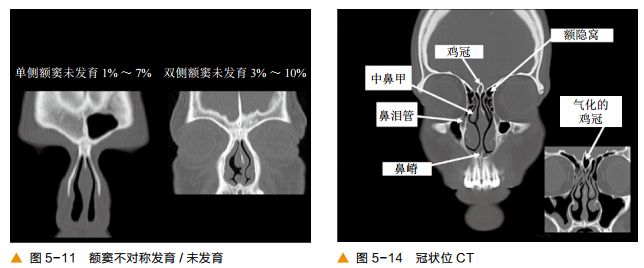 影像PPT - 颅底及鼻窦CT轴冠矢解剖-8