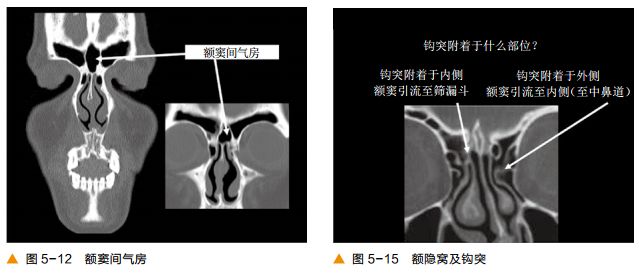 影像PPT - 颅底及鼻窦CT轴冠矢解剖-9