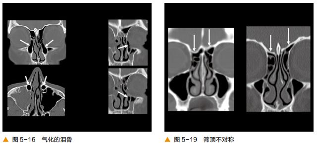 影像PPT - 颅底及鼻窦CT轴冠矢解剖-10
