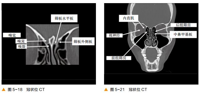 影像PPT - 颅底及鼻窦CT轴冠矢解剖-12
