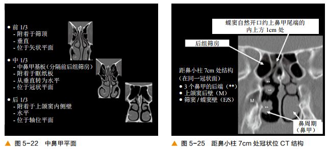影像PPT - 颅底及鼻窦CT轴冠矢解剖-13
