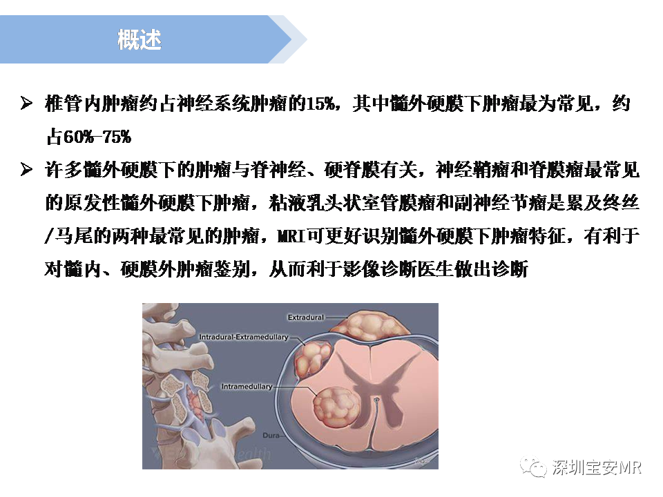 影像PPT - 【PPT】脊髓外硬膜下肿瘤的影像表现-2
