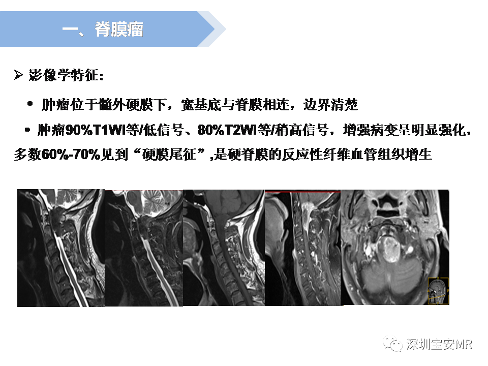 影像PPT - 【PPT】脊髓外硬膜下肿瘤的影像表现-6