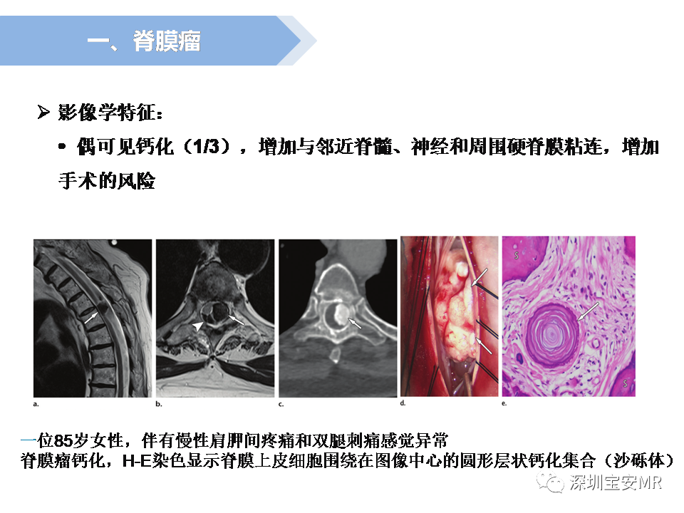 影像PPT - 【PPT】脊髓外硬膜下肿瘤的影像表现-8