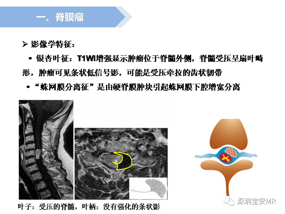 影像PPT - 【PPT】脊髓外硬膜下肿瘤的影像表现-7