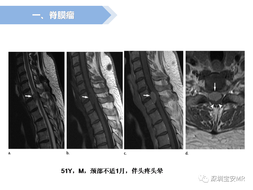 影像PPT - 【PPT】脊髓外硬膜下肿瘤的影像表现-9