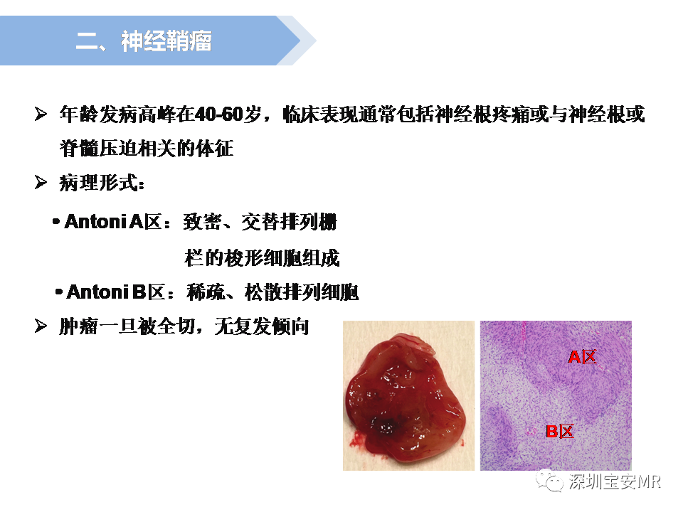 影像PPT - 【PPT】脊髓外硬膜下肿瘤的影像表现-11