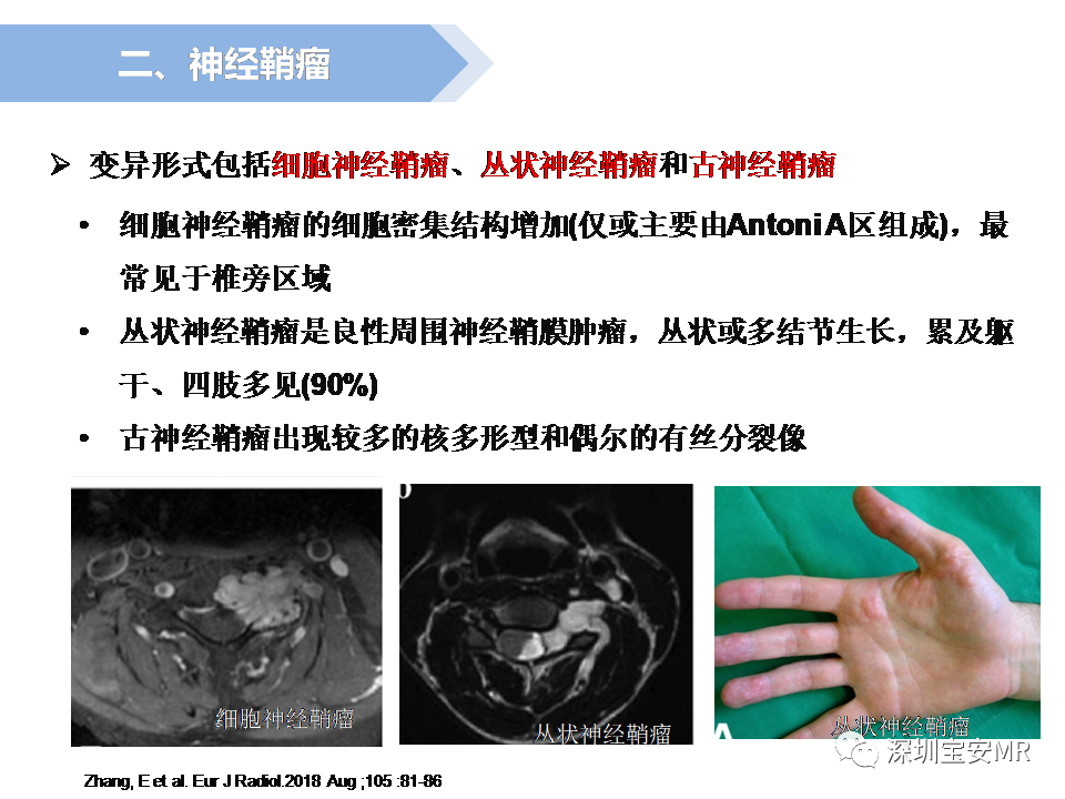 影像PPT - 【PPT】脊髓外硬膜下肿瘤的影像表现-12