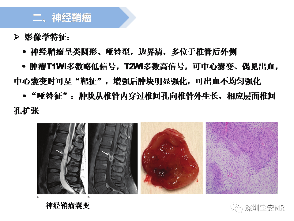 影像PPT - 【PPT】脊髓外硬膜下肿瘤的影像表现-13