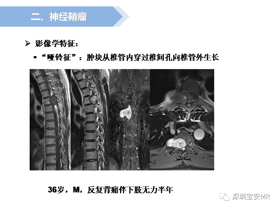 影像PPT - 【PPT】脊髓外硬膜下肿瘤的影像表现-14