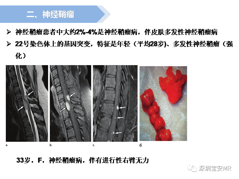 影像PPT - 【PPT】脊髓外硬膜下肿瘤的影像表现-15
