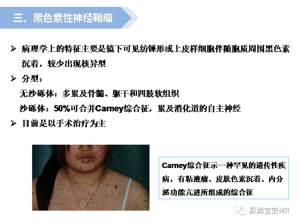影像PPT - 【PPT】脊髓外硬膜下肿瘤的影像表现-17