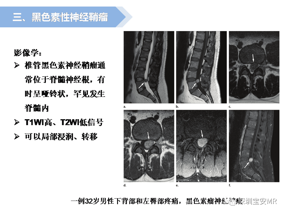 影像PPT - 【PPT】脊髓外硬膜下肿瘤的影像表现-18
