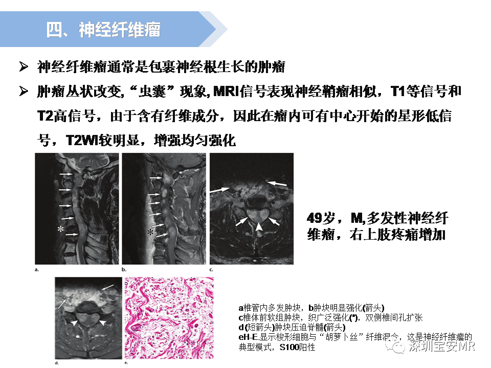 影像PPT - 【PPT】脊髓外硬膜下肿瘤的影像表现-20
