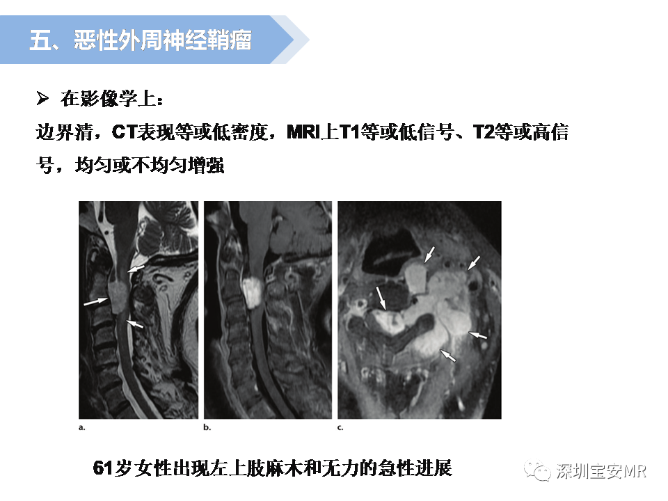 影像PPT - 【PPT】脊髓外硬膜下肿瘤的影像表现-23