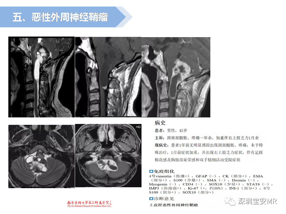 影像PPT - 【PPT】脊髓外硬膜下肿瘤的影像表现-24