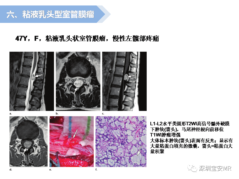 影像PPT - 【PPT】脊髓外硬膜下肿瘤的影像表现-27