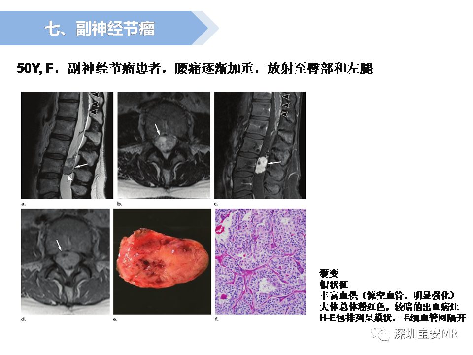 影像PPT - 【PPT】脊髓外硬膜下肿瘤的影像表现-30