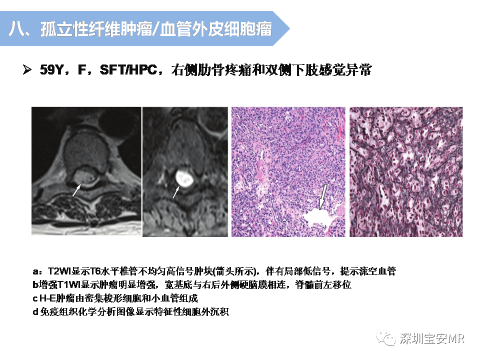影像PPT - 【PPT】脊髓外硬膜下肿瘤的影像表现-33