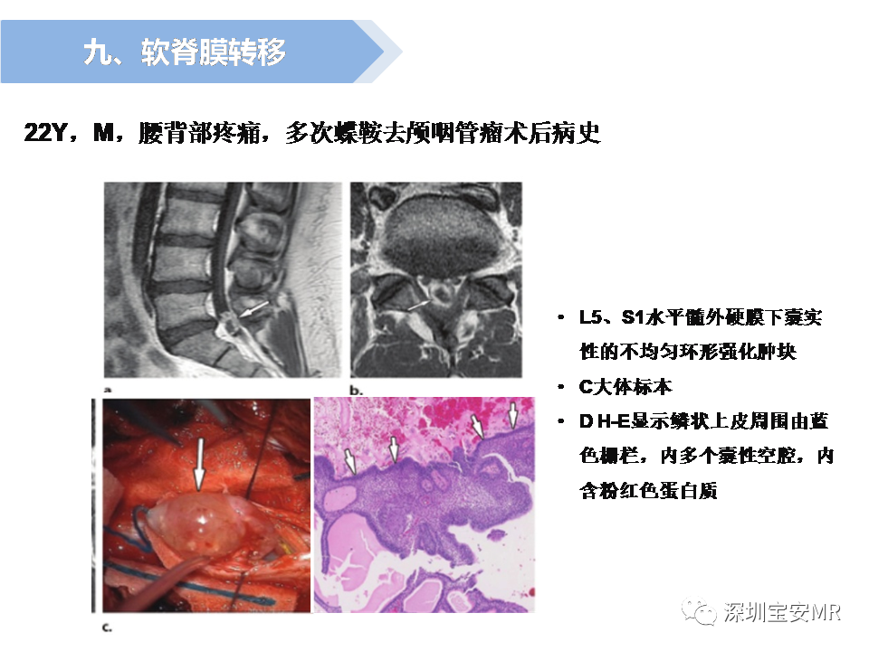 影像PPT - 【PPT】脊髓外硬膜下肿瘤的影像表现-35