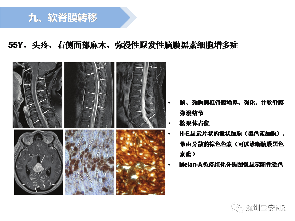 影像PPT - 【PPT】脊髓外硬膜下肿瘤的影像表现-36