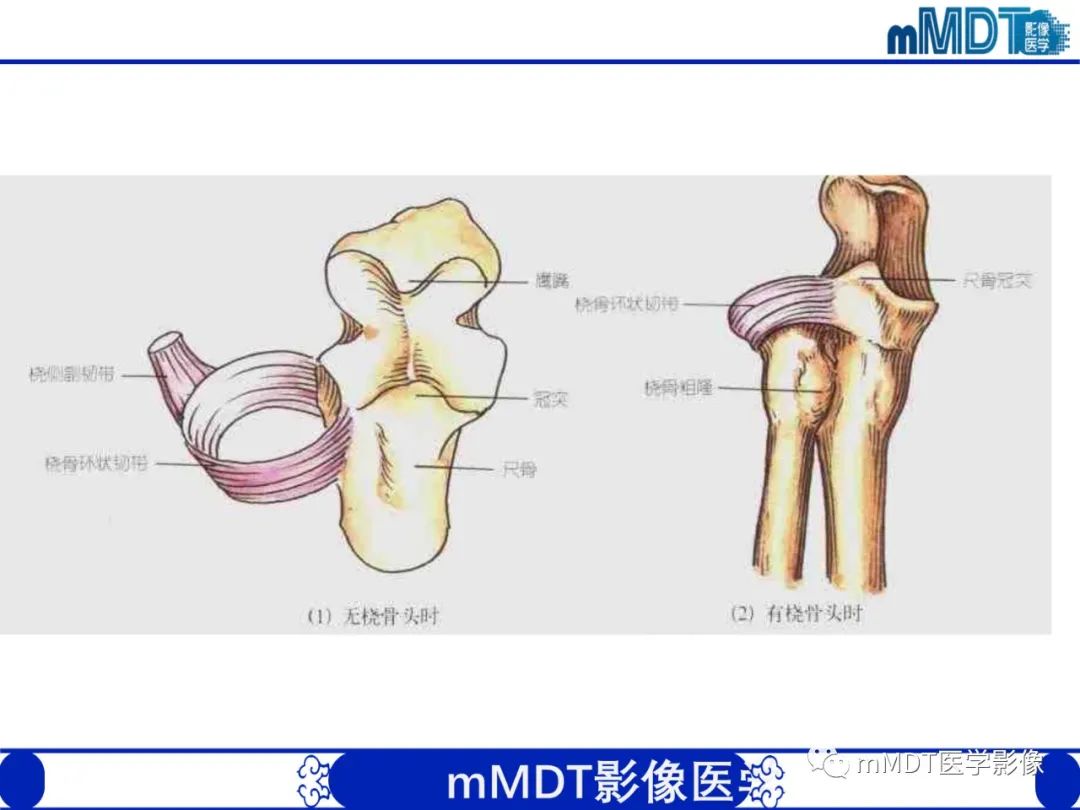 影像PPT - 【PPT】儿童肘关节损伤影像-6