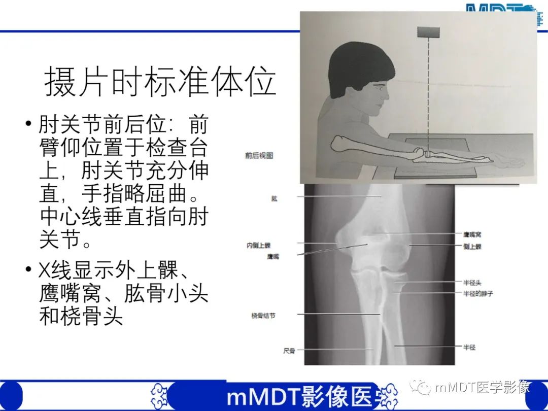 影像PPT - 【PPT】儿童肘关节损伤影像-7
