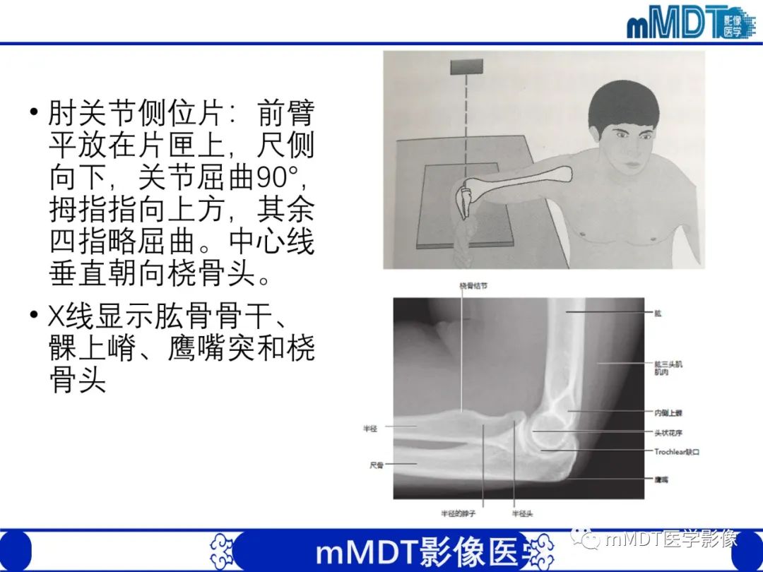 影像PPT - 【PPT】儿童肘关节损伤影像-8