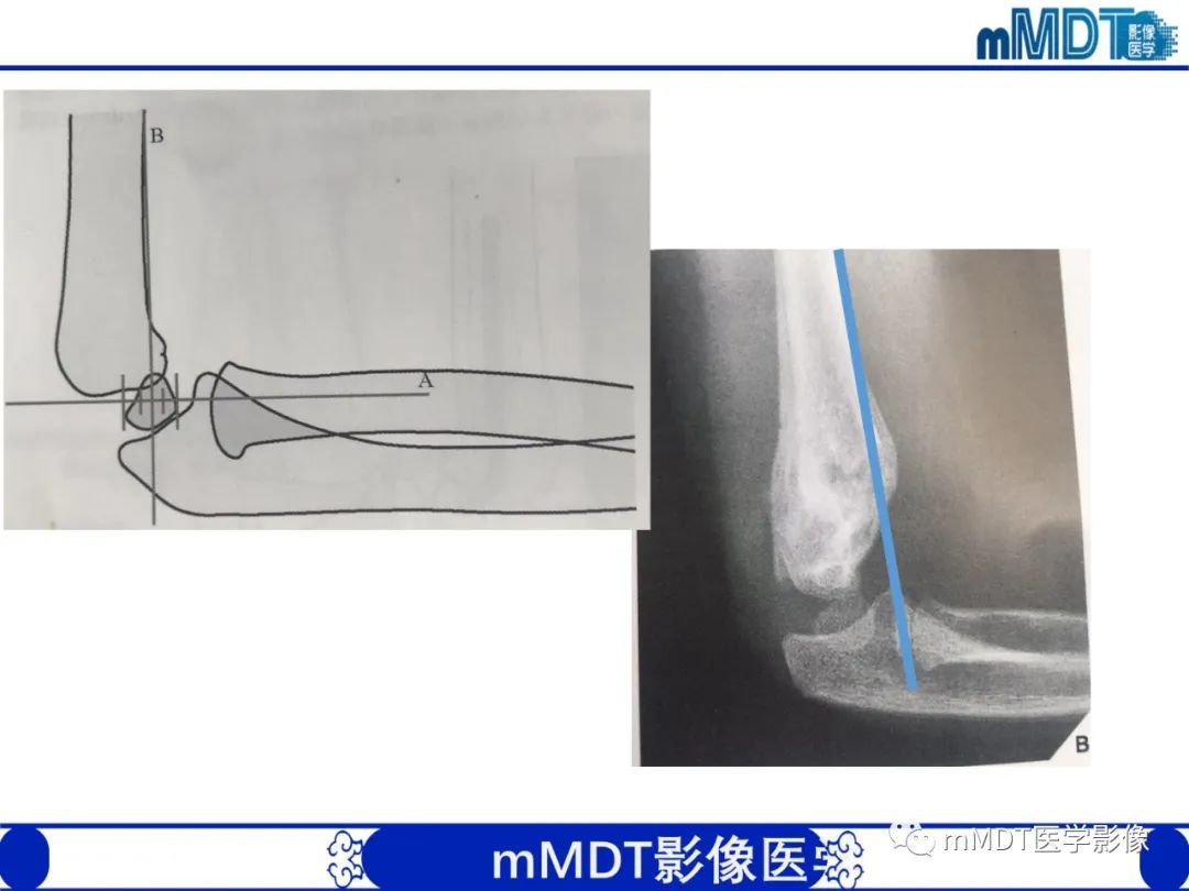 影像PPT - 【PPT】儿童肘关节损伤影像-10
