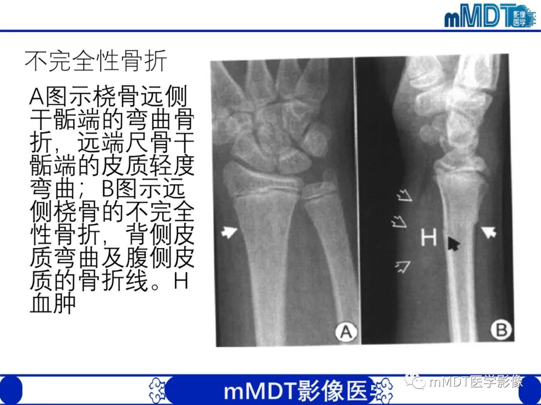 影像PPT - 【PPT】儿童肘关节损伤影像-14