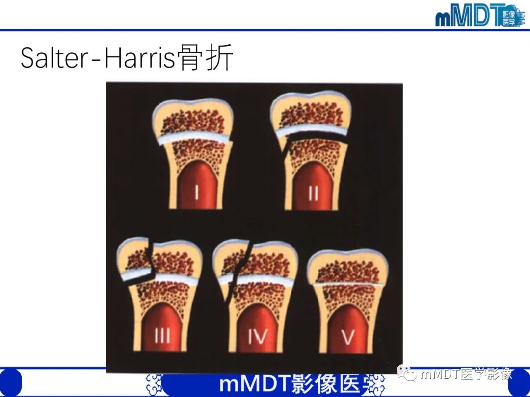 影像PPT - 【PPT】儿童肘关节损伤影像-16