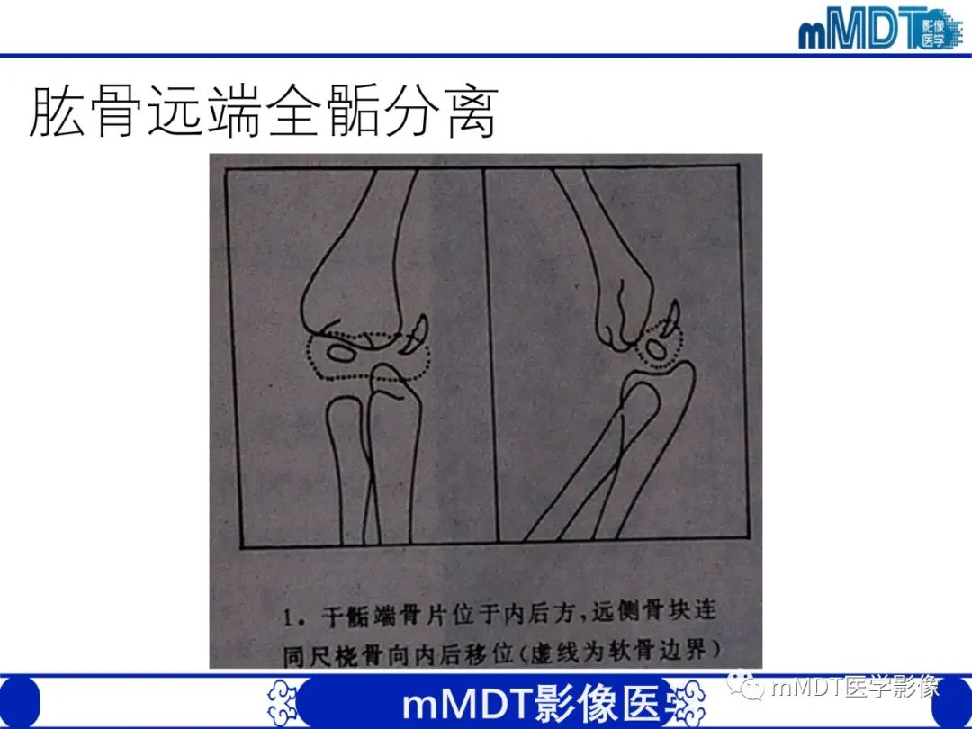 影像PPT - 【PPT】儿童肘关节损伤影像-22