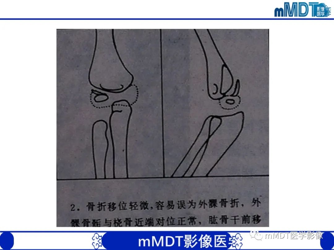 影像PPT - 【PPT】儿童肘关节损伤影像-23