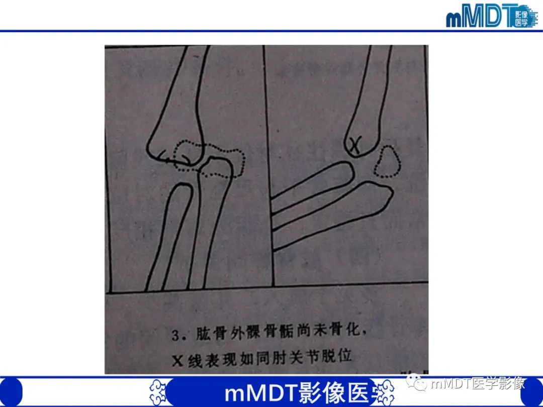 影像PPT - 【PPT】儿童肘关节损伤影像-24