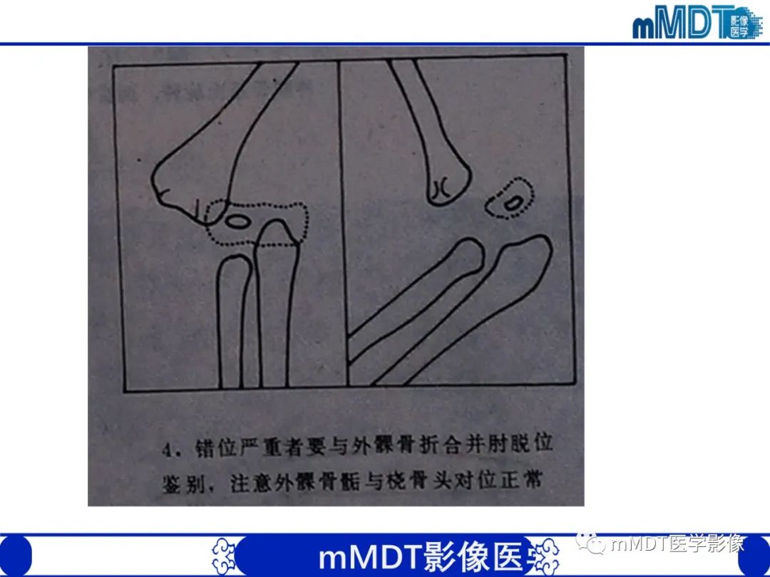 影像PPT - 【PPT】儿童肘关节损伤影像-25