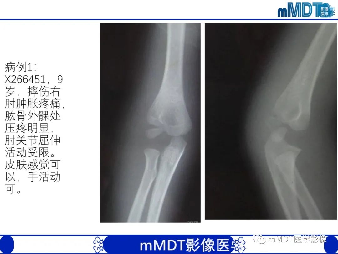 影像PPT - 【PPT】儿童肘关节损伤影像-26