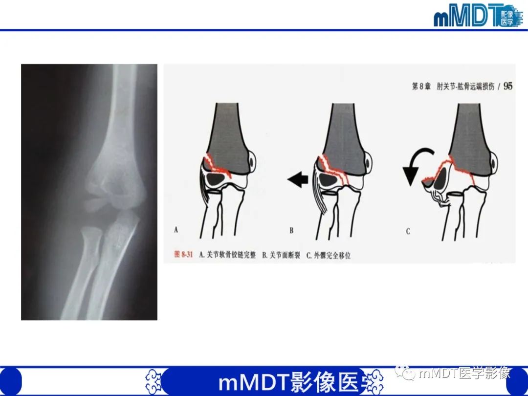 影像PPT - 【PPT】儿童肘关节损伤影像-27