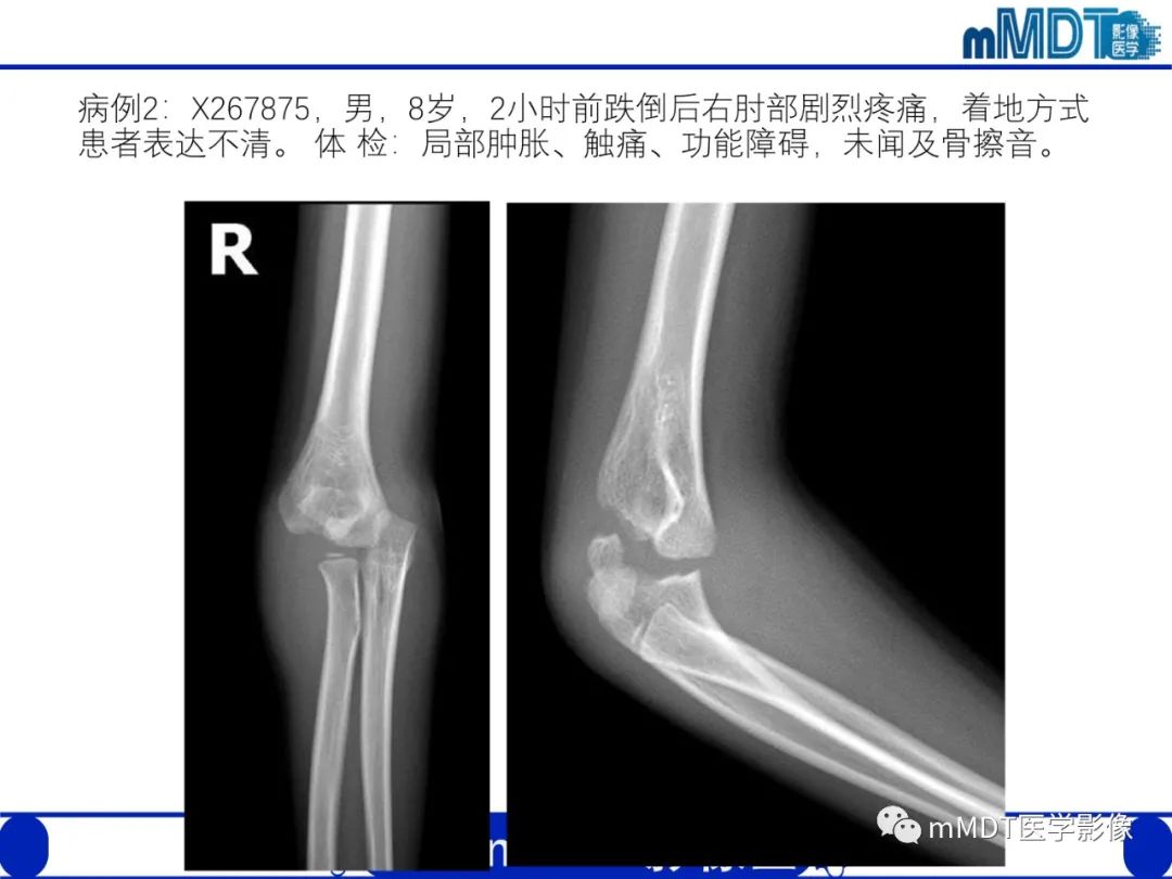 影像PPT - 【PPT】儿童肘关节损伤影像-28