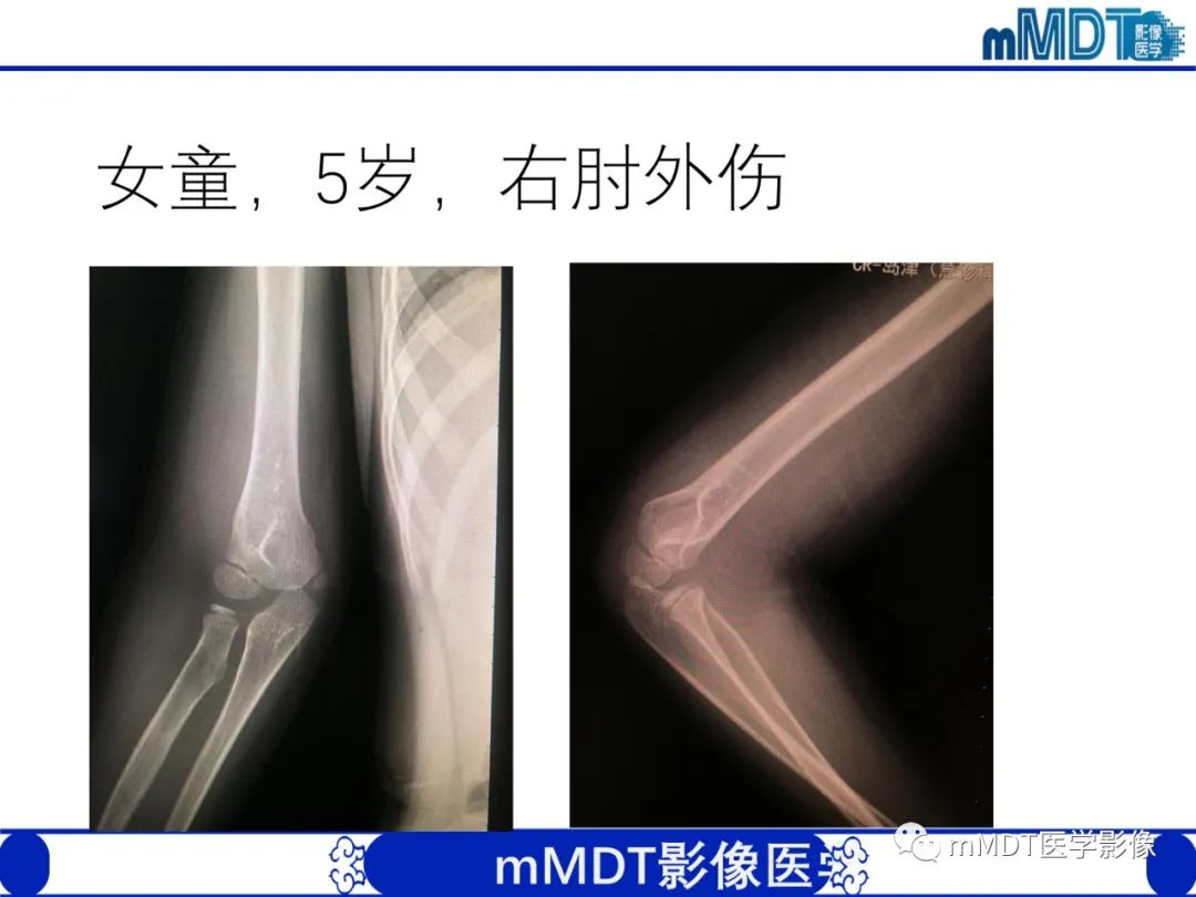 影像PPT - 【PPT】儿童肘关节损伤影像-32