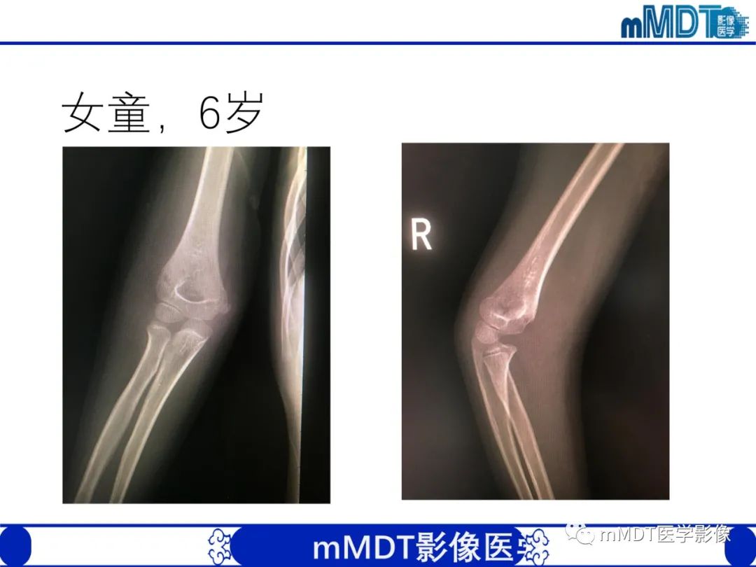 影像PPT - 【PPT】儿童肘关节损伤影像-33