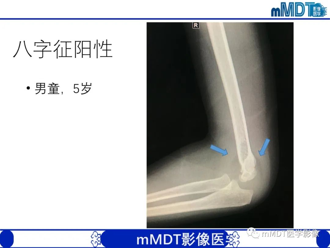 影像PPT - 【PPT】儿童肘关节损伤影像-35