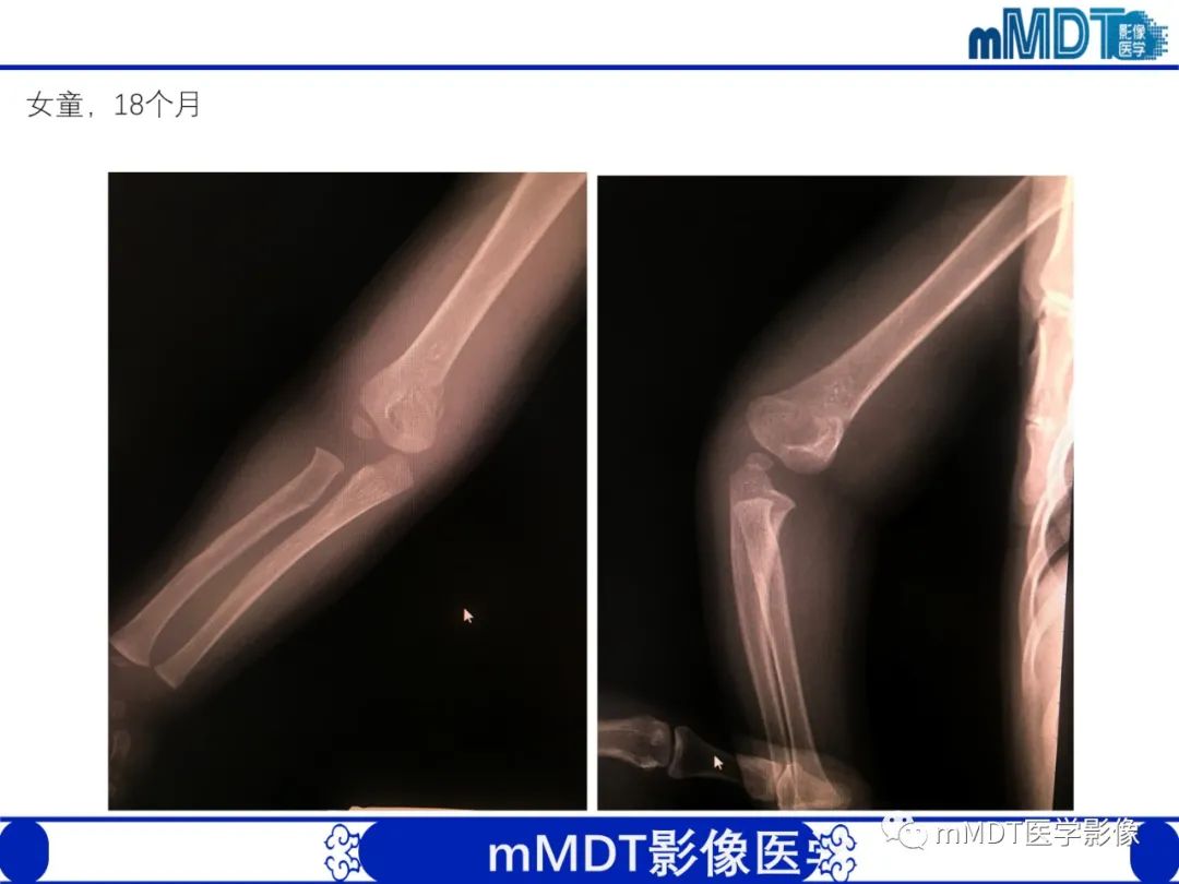 影像PPT - 【PPT】儿童肘关节损伤影像-40