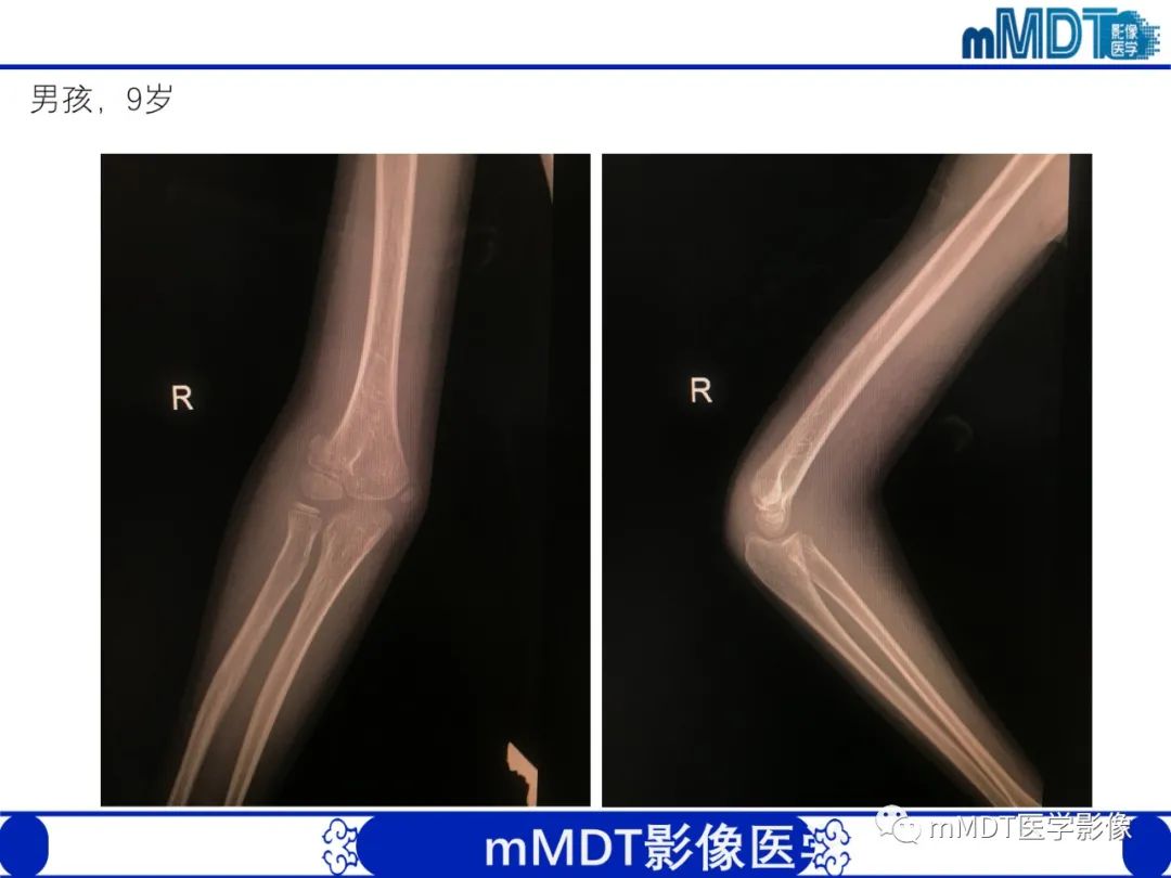 影像PPT - 【PPT】儿童肘关节损伤影像-37