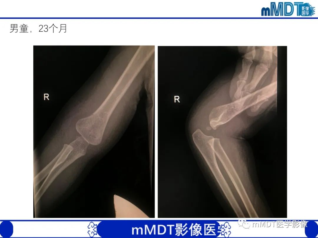 影像PPT - 【PPT】儿童肘关节损伤影像-38