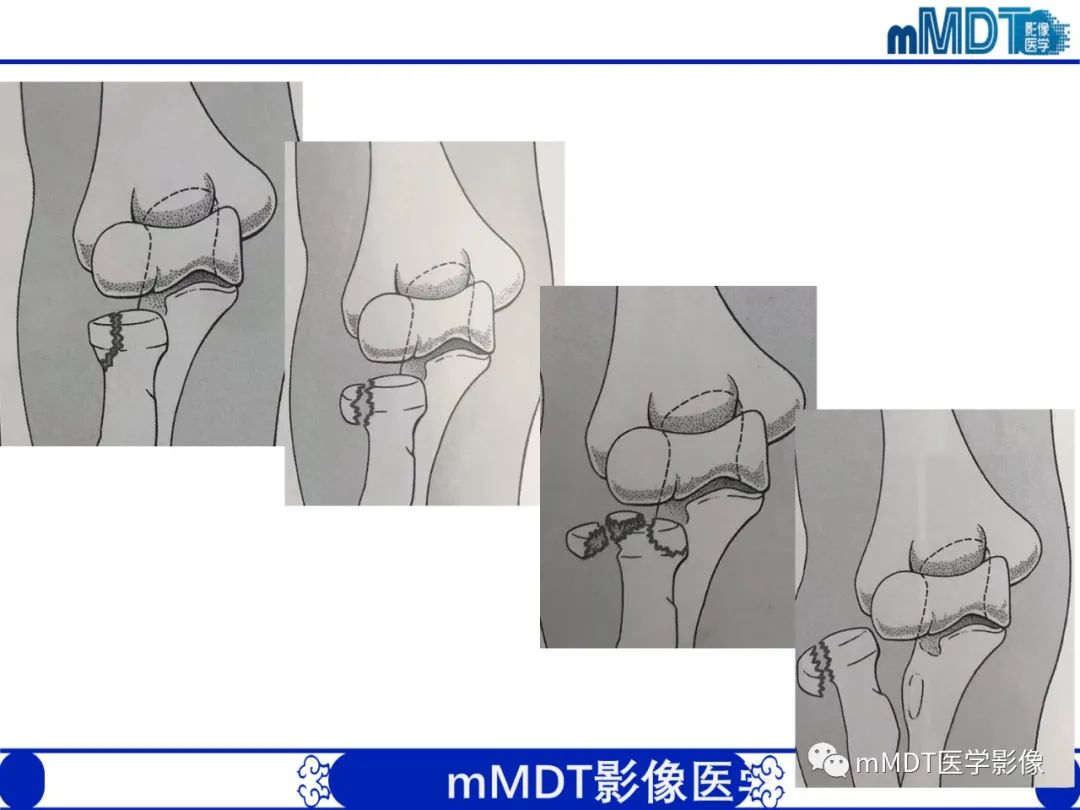 影像PPT - 【PPT】儿童肘关节损伤影像-42