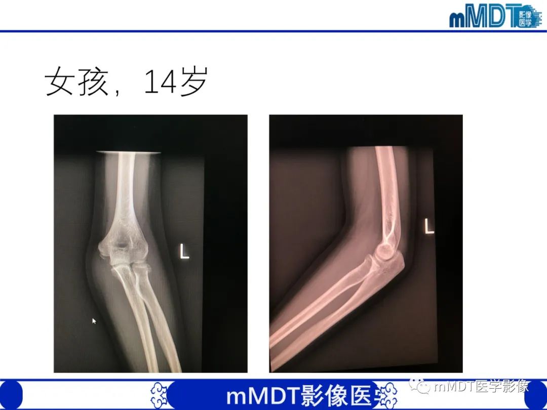 影像PPT - 【PPT】儿童肘关节损伤影像-43