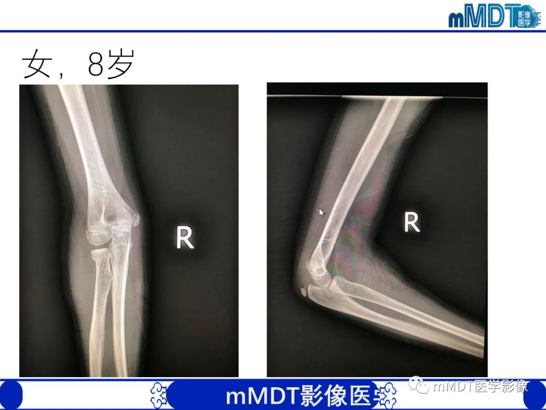 影像PPT - 【PPT】儿童肘关节损伤影像-44